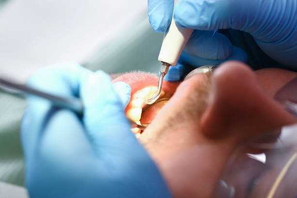 Best Emergency Tooth Extraction in Portales, NM